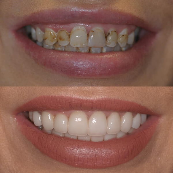 Before and after close up of a patient's smile.
