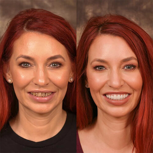 A before an after image showing the effects of a woman's cosmetic dental work.