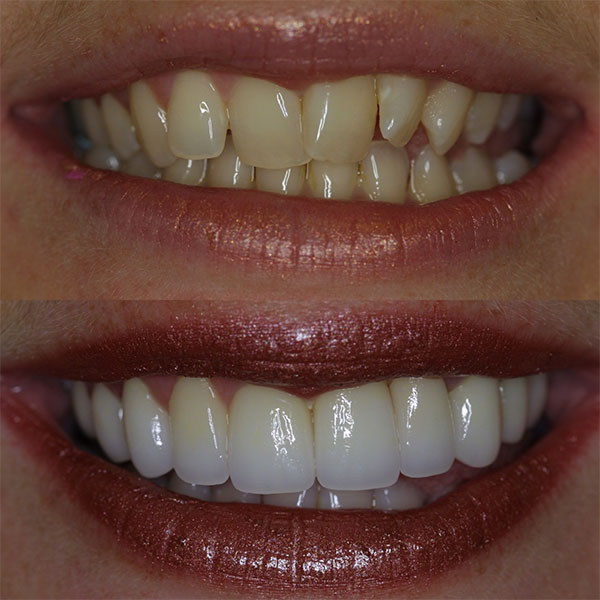 A before and after image of a woman's smile after cosmetic dentistry.