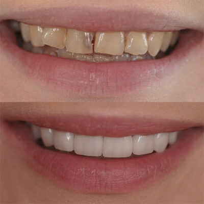 Smile transformation with before picture on the top and the after picture on the bottom